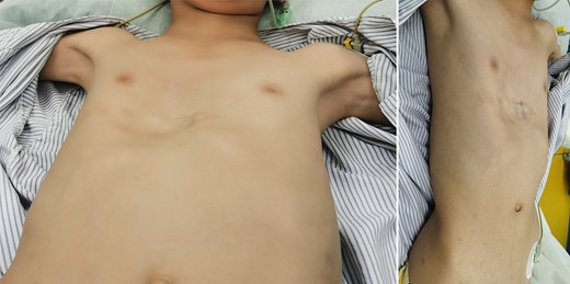 Appearance of chest wall before reoperation.