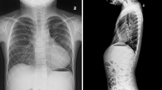Chest X-ray examination before reoperation.