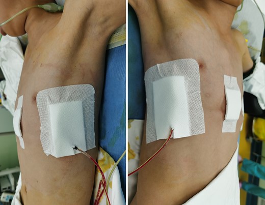 Appearance of chest wall after reoperation.