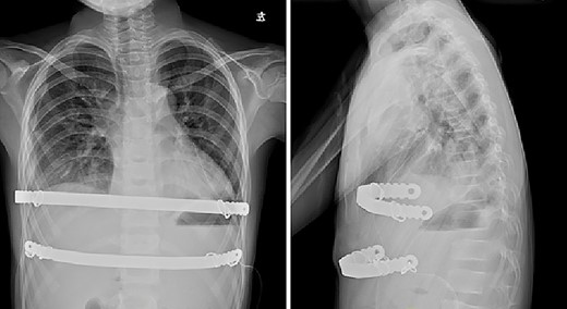 Chest X-ray examination after reoperation.