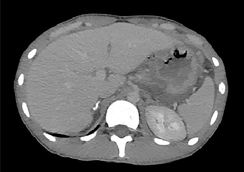An axial image from the abdominal CT scan demonstrates discontinuity of the stomach wall and a connection with the free air, suggesting perforation at this level.