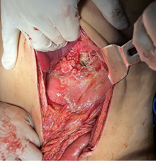 Intraoperative findings: full thickness perforation on the lesser curvature of the stomach measuring 4 × 2 cm in length in the anterior wall.