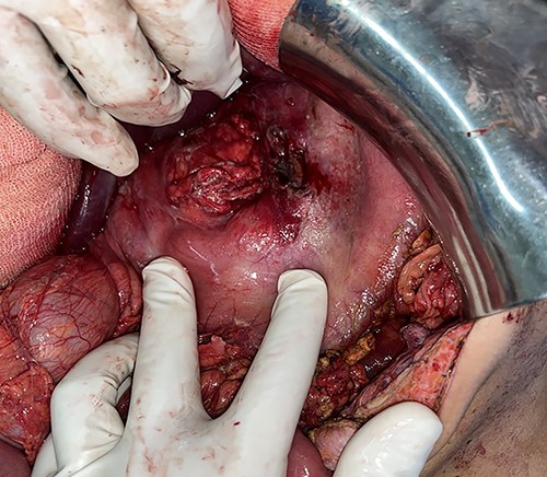 Intraoperative findings: perforation lesion along the posterior gastric wall measuring 1 × 1 cm.