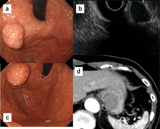 (a) A submucosal tumor measuring ∼2 cm is found at the posterior wall of the upper body of the gastric body near the EGJ by upper endoscopy. (b) Endoscopic ultrasonography shows a gastric hypoechoic tumor from the fourth layer suggesting GIST. (c) The tumor shows increase in size by ∼1 cm compared with 1 year ago. (d) CT reveals an intraluminal growth type submucosal tumor measuring 3.5 cm in diameter and no metastasis.