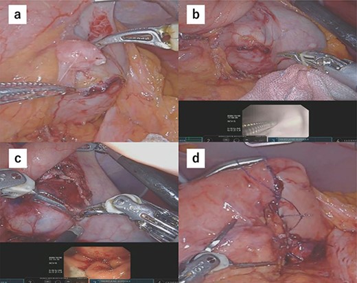 (a) After mobilization of the gastric posterior wall, another tumor, which looked like a lymph node, was identified and resected. (b) Upper endoscopy shows the tumor and the wedge pushed using biopsy forceps; in this manner, we confirmed the minimum resection line. (c) The minimum partial resection was performed using Maryland bipolar forceps according to the line confirmed from inside and outside the stomach. (d) Reconstruction was performed using Albert–Lembert sutures.