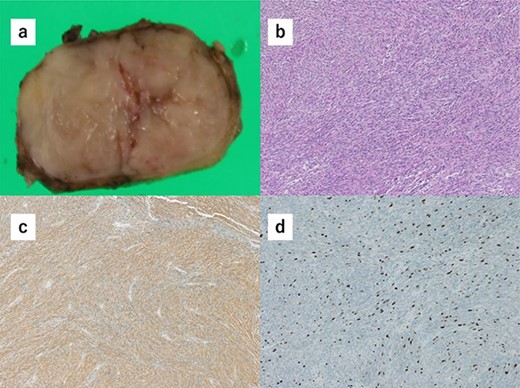 (a) Macroscopically, the partial gastrectomy specimen measured 35 mm × 20 mm. (b) The histopathology of the specimens reveals that the tumors comprise bundle-like proliferation of spindle-shaped cells and are positive for c-kit. (c) The tumors are positive for c-kit. (d) The mitotic rate was 3 per 50 HPF, and Ki67 showed a low proliferation rate.