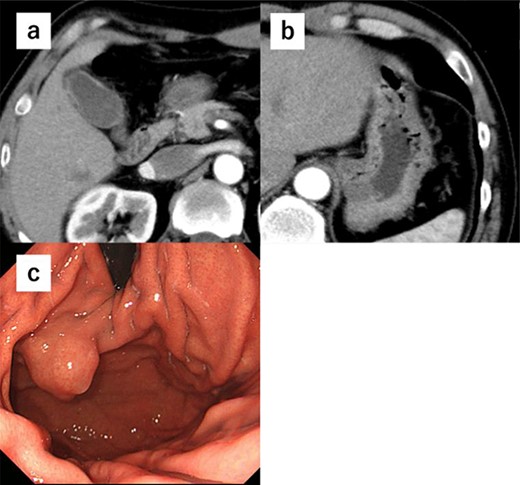 (a) CT shows cholecystitis, and no gall bladder is found. (b) CT shows cholecystitis, and no gall bladder was found. A submucosal tumor measuring 3.5 cm in diameter was incidentally detected. (c) Upper endoscopy reveals the tumor in the anterior wall of the gastric cardia near the EGJ.