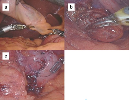 (a) We performed robot-assisted cholecystectomy. (b) The tumor location was confirmed endoscopically, and the tumor was resected minimally. (c) Reconstruction was performed by Albert–Lembert suture.