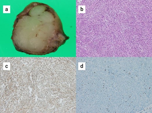 (a) Macroscopically, the partial gastrectomy specimen measures 25 mm × 20 mm. (b) Histopathology of the specimens reveals that the tumors consist of bundle-like proliferation of spindle-shaped cells and are positive for c-kit. (c) The tumors are positive for c-kit. (d) The mitotic rate was 7 per 10 HPF, and the Ki67 index rate was 7%.