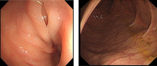 Colonoscopy findings. Torsion was observed in sigmoid rectum. No mucosal necrosis was observed.