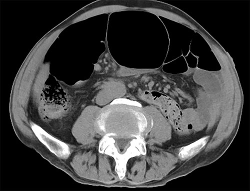 CT findings. CT showed dilation of the oral intestinal tract was observed.
