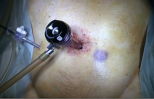 Surgical findings. Twelve millimeter port was inserted at the umbilical site and an additional 5-mm port was placed in the right midline for observation.