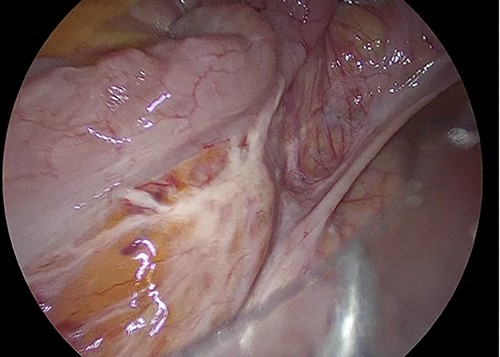 Surgical findings. Sigmoid colon was elongated and there was scar near the SD junction.