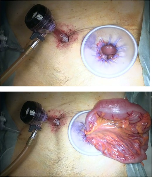 Method of Sharon operation. Sigmoid colon was raised outside the wound at the opposite of Mc Burney’s point.