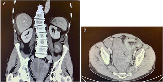 CT abdomen and pelvis with contrast in (A) anterior–posterior and (B) coronal views identified a rectovesical hematoma mass measuring 8.2 × 7 cm.