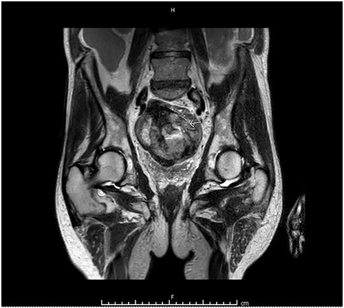 MRI abdomen and pelvis with contrast identified small bowel involvement in the lateral side wall of the hematoma within the pelvis.