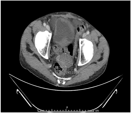 CT abdomen and pelvis with contrast identified small bowel distention and a mass-like focus measuring 5 × 3.8 cm in the pelvic region.