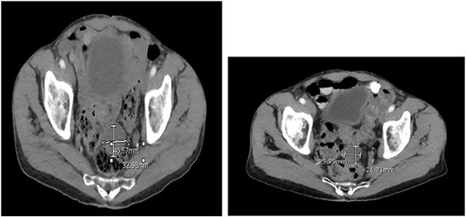 CT abdomen and pelvis at (A) 2- and (B) 4 months follow-up. The pelvic mass measured 4.1 × 3.3 and 2.6 × 2.7 cm, respectively.