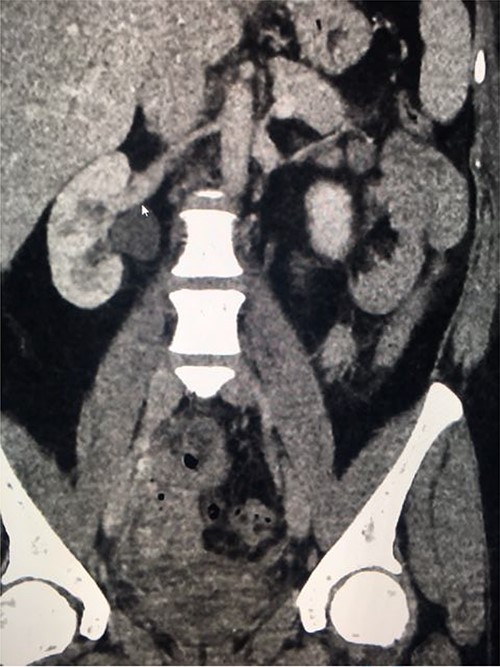 Coronal nephrogenic phase CT urogram showing hydronephrosis of the right renal pelvis.
