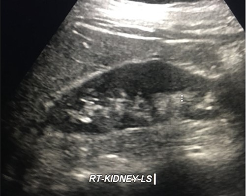 Follow-up US kidneys revealed no hydronephrosis.