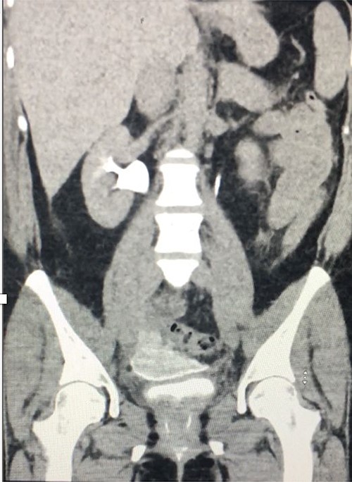 Coronal delayed phase CT urogram showing pooling of contrast in the pelvis.