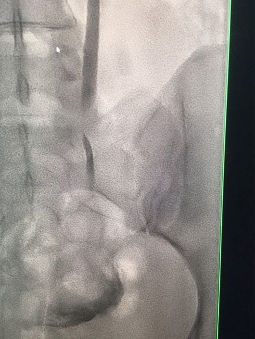 Antegrade urethrogram showing proximal ureter opacification with contrast, with an abrupt end point consistent with transected right distal ureter.