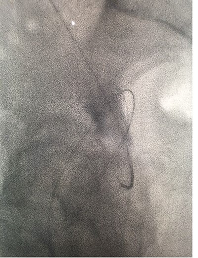 Fluoroscopic images showing the antegrade Amplatz gooseneck snare catheter attempting to grasp the retrograde wire.