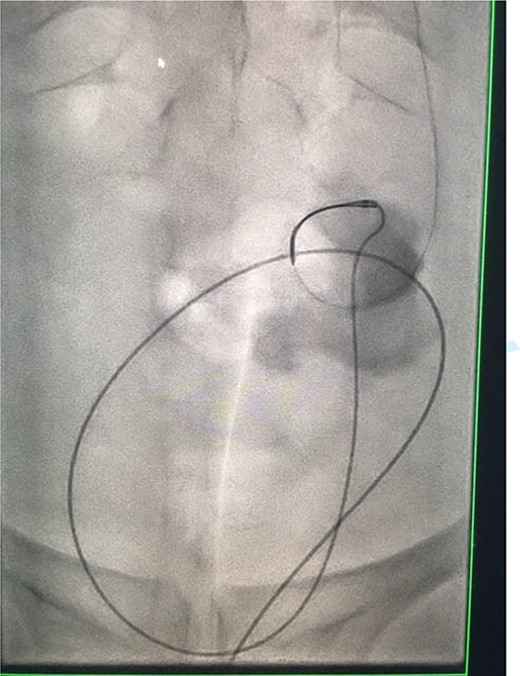 Fluoroscopic images showing the antegrade Amplatz gooseneck snare catheter attempting to grasp the retrograde wire.