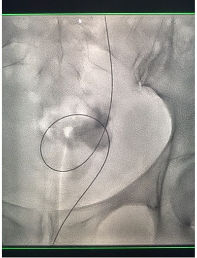 Fluoroscopic images showing the retrograde wire successfully retrieved and brought externally via the nephrostomy site, achieving through-and-through wire access.