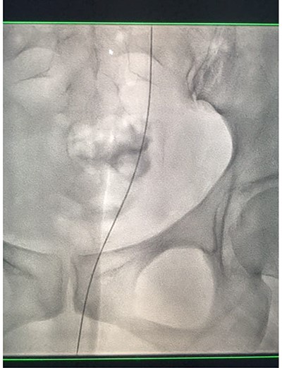Fluoroscopic images showing the retrograde wire successfully retrieved and brought externally via the nephrostomy site, achieving through-and-through wire access.