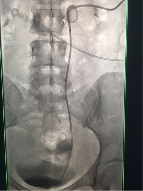 Fluoroscopic images demonstrating the successfully re-connected right ureter with a nephroureteric stent in situ.