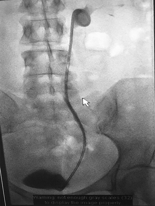 Fluoroscopic image showing ureteric stent.
