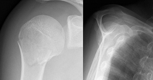 Original X-ray showing surgical neck fracture.