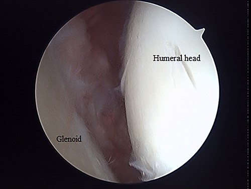 Posterior endoscopy of the shoulder joint showing no reimpression or exposure of subchondral bone.