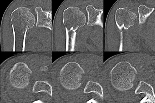 Original CT scan showing impression fracture and surgical neck fracture.