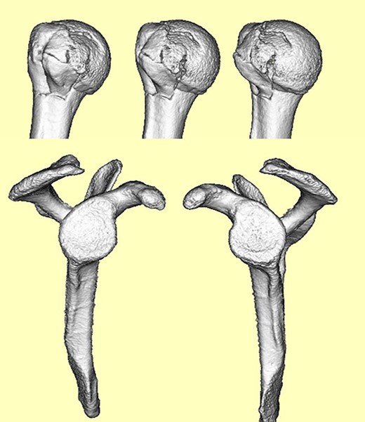 3D-CT scan showing approximately 20% of articular surface of the right proximal and no glenoid defect, indicating no posterior shoulder dislocation.