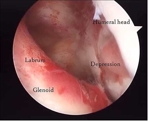 Posterior arthroscopy of the right shoulder joint. The right is the humeral head side, and the left is the glenoid side. Impression of the humeral head was noted, but the posterior labrum was not damaged.