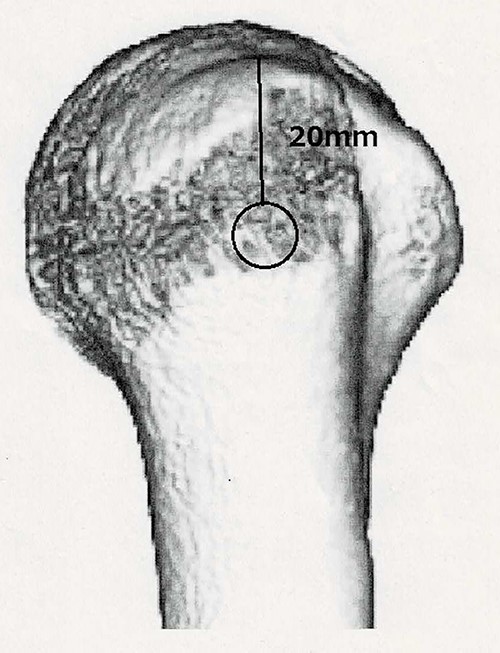 To correctly place the cortical window, we referenced Marco’s report. We took a distance of 20 mm from merkmal against they took 25 mm.