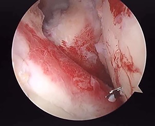 Posterior arthroscopy of the right shoulder joint showing a reduced depressed surface and the Kirschner wire for reduction guide.