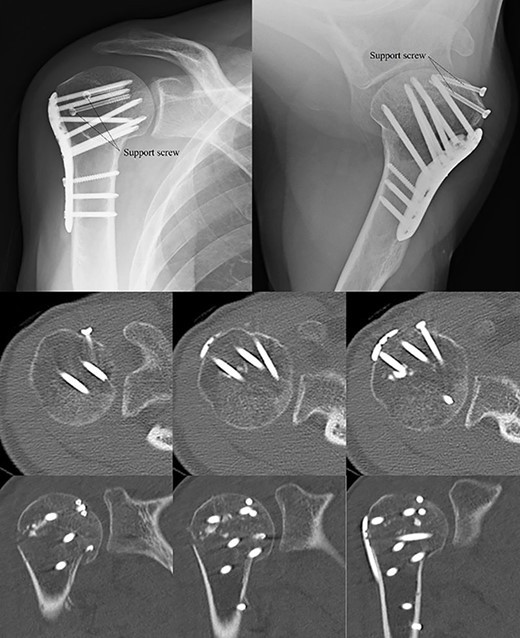 Postoperative X-ray and CT scan showing sustained anatomical reconstruction of articular surfaces and no signs of osteoarthritis.