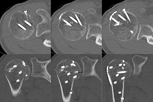 Two years later, pre-implant removal CT showed that the reduction in the depressed surface had been maintained with no obvious arthritic changes.