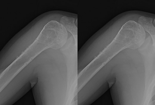Post-implant removal X-ray showing that the alignment had been maintained.