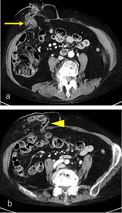 (a) CT scan revealed a prolapse of the transverse colon on the oral side (arrow); (b) CT scan revealed a prolapse of the transverse colon on the anal side (triangle).