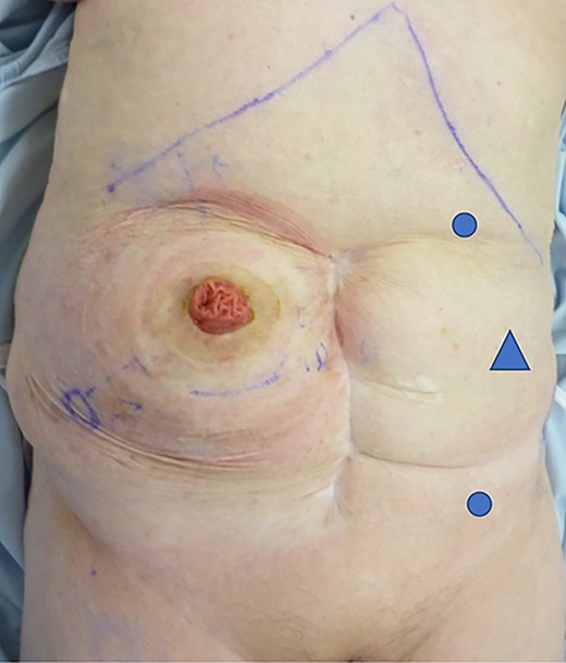 Port replacement: two 5-mm ports (circle) and 12 mm port (triangle) placed vertically in the left abdominal quadrants.