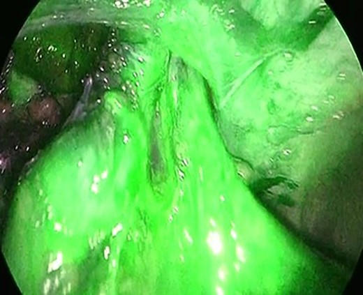 The hernia orifice was exposed and intestinal blood flow was evaluated by indocyanine green.