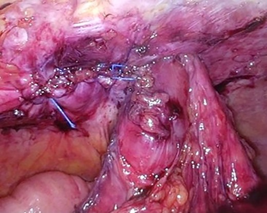 The hernia defect was closed with one Surgipro™ and 3-0Vloc™ suture.