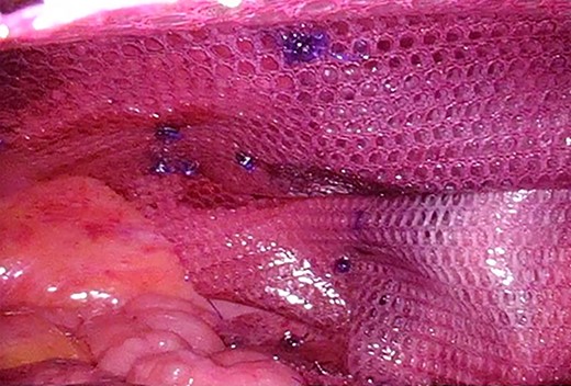 The mesh was fixed using Absorbable Tack™.
