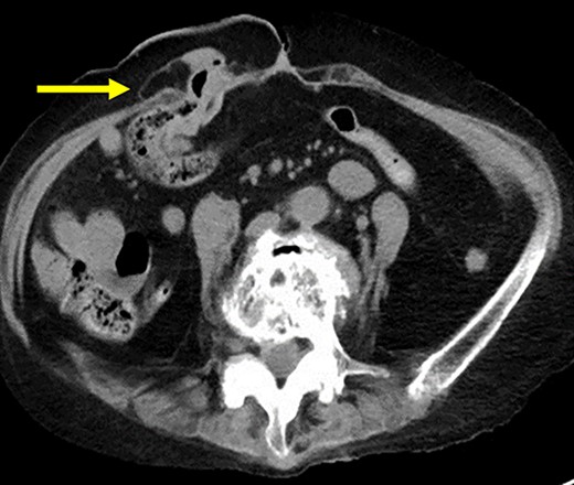 CT scan revealed no recurrence of the transverse colon on the oral side (arrow).