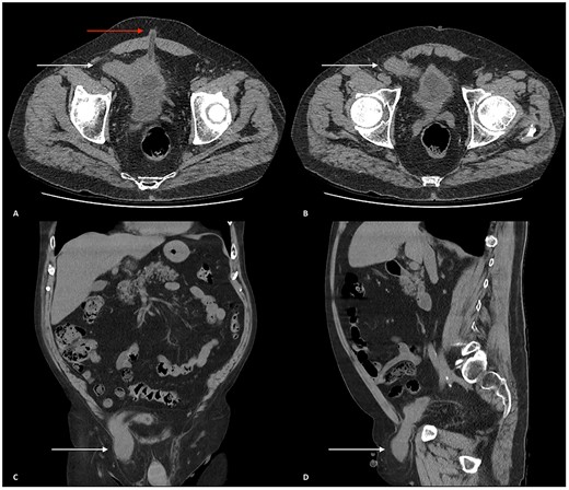 (A and B) Axial CT scan of the abdomen and pelvis showing the urinary bladder herniating into the right inguinal canal (white arrows). (A) Urinary bladder extending towards the right deep inguinal ring before herniating into the right inguinal canal. An umbilical hernia can also be seen (red arrow). (B) Urinary bladder herniating into the inguinal canal. (C) Coronal CT scan of the abdomen and pelvis displaying the urinary bladder herniating into the right inguinal canal and traversing through the right scrotum (white arrow). (D) Sagittal CT scan of the abdomen and pelvis showing the urinary bladder herniating through the right inguinal canal, through the right spermatic cord and positioned superiorly above the right testicle.