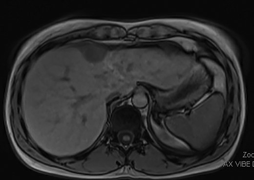Pre-operative MRI image showing a 3.6 × 2.4 cm mass over segment IVa of the liver with possible parenchymal invasion.